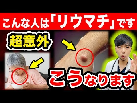 画像 ⚠放置危険‼知らないと後悔する『リウマチ』SOSサイン【関節以外の〇〇に注意‼】現役医師がリウマチ/膠原病の初期症状や検査/治療方法を解説
