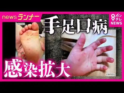 画像 大人も注意「手足口病」が感染拡大　飛沫感染で特効薬もなし　対策方法は？医師が解説　大阪・京都は警報レベルに　